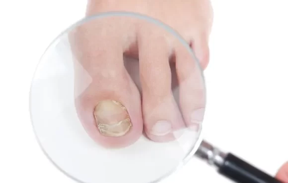 Toenail fungus treatment michigan